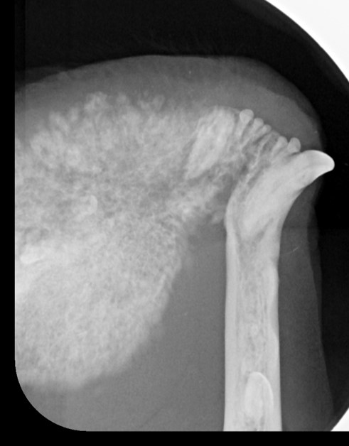 complicated and surgical extraction x-ray