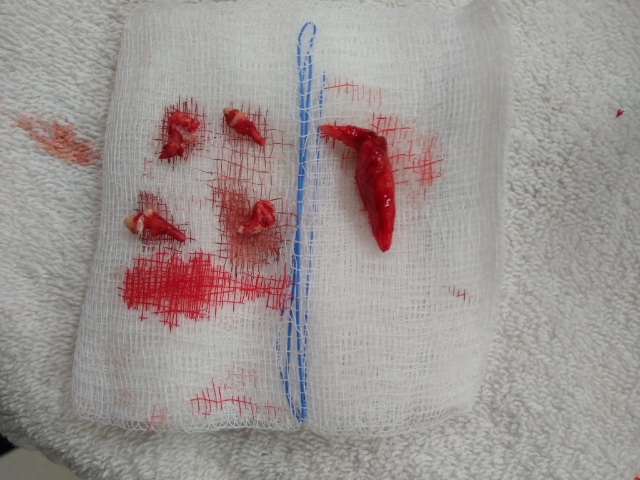 extracted teeth